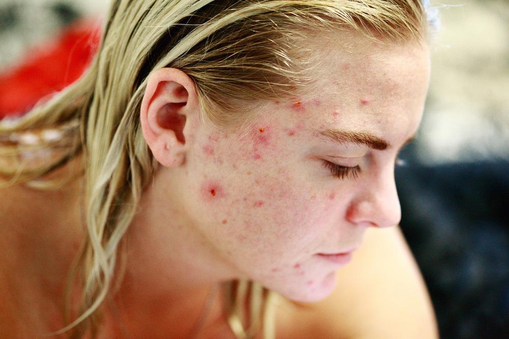 Dream of Treating and Dealing With Acne